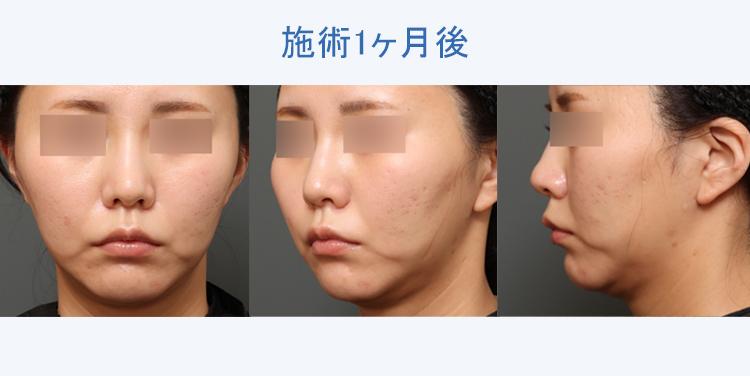 フェイスタイト+顔の脂肪吸引 施術1ヶ月後の症例写真