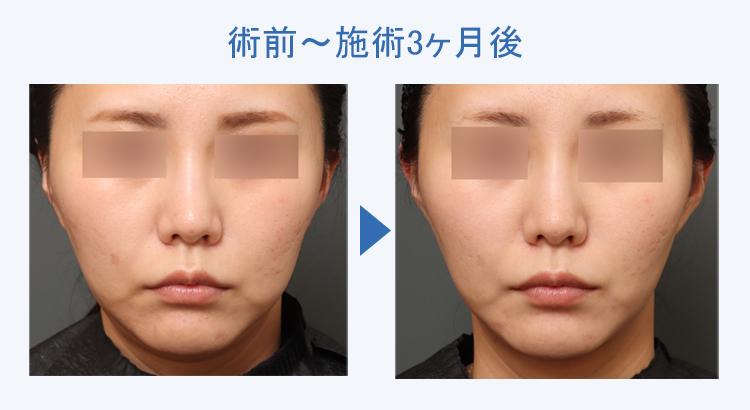 フェイスタイト+顔の脂肪吸引 術前術後の比較1