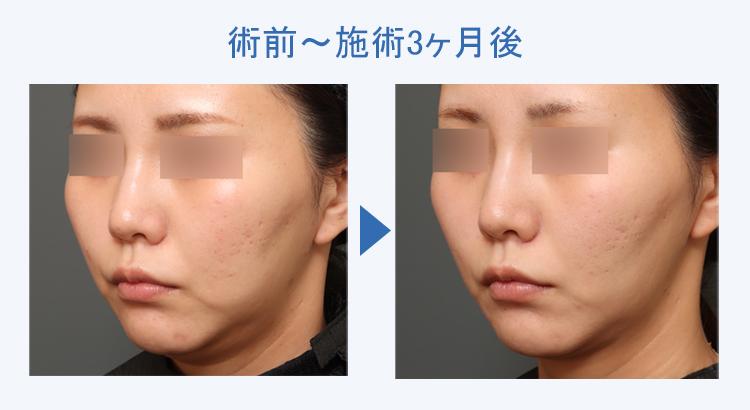 フェイスタイト+顔の脂肪吸引 術前術後の比較2