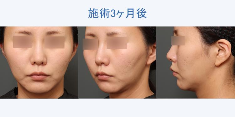 フェイスタイト+顔の脂肪吸引 施術3ヶ月後の症例写真