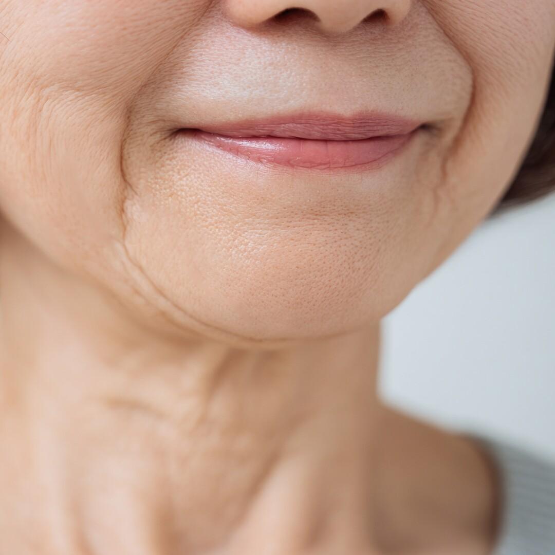 40代以降など、年齢による皮膚・脂肪のたるみ