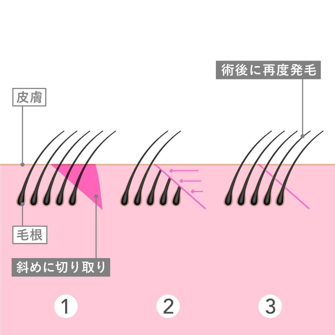 傷跡が目立ちにくい工夫