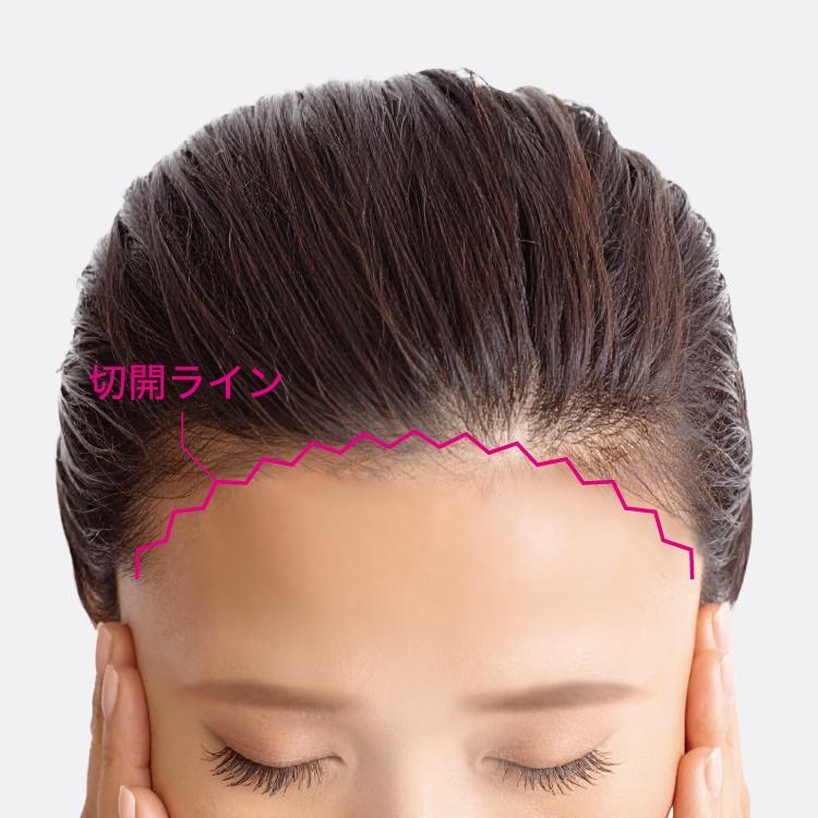 傷跡が目立ちにくい工夫