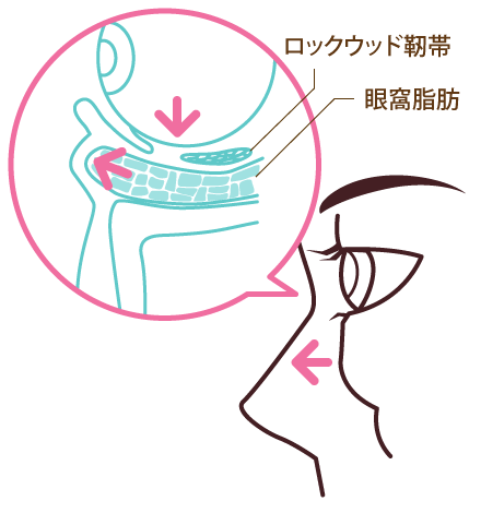 目の下のクマ・たるみの原因1：眼窩脂肪の突出