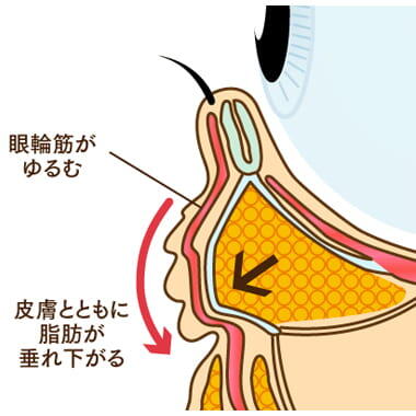 目の下のクマ・たるみの原因2：眼輪筋のゆるみ