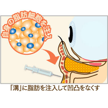 STEP2：「皮下脂肪の減少」にアプローチ