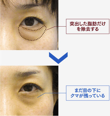 3Dパーフェクトアイリフト