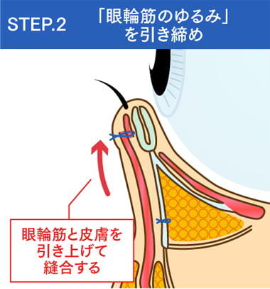 STEP2:「眼輪筋のゆるみ」にアプローチ