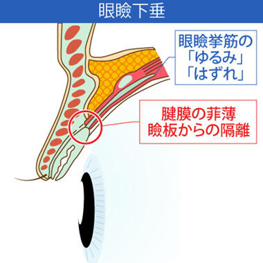 3. 腱膜性眼瞼下垂の治療は保険適用内！