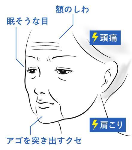 4. 眼瞼下垂の負の連鎖とは？