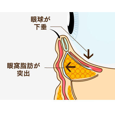 1-2. 目元の筋力の低下