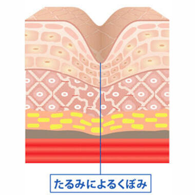 このような真皮層の衰退が起こる原因は、加齢による肌の老化と外部刺激による肌ダメージの2つです。