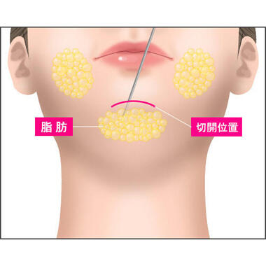 ステップ1：頬・アゴ下の脂肪を吸引