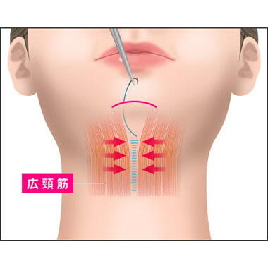 ステップ3：広頚筋を引き寄せ縫合