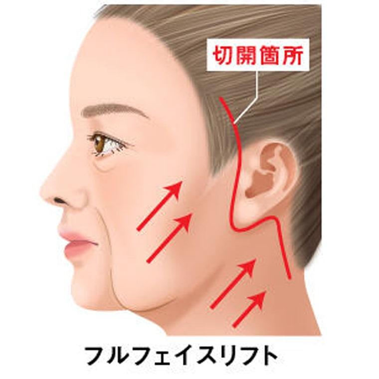 フルフェイスリフトとは？