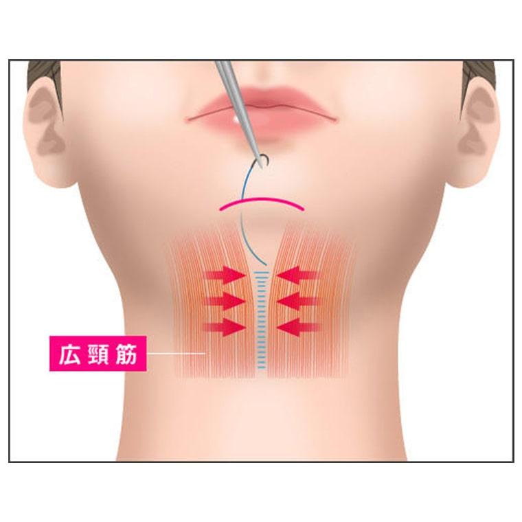 二重アゴ筋肉縛り（ペリカン手術）とは？