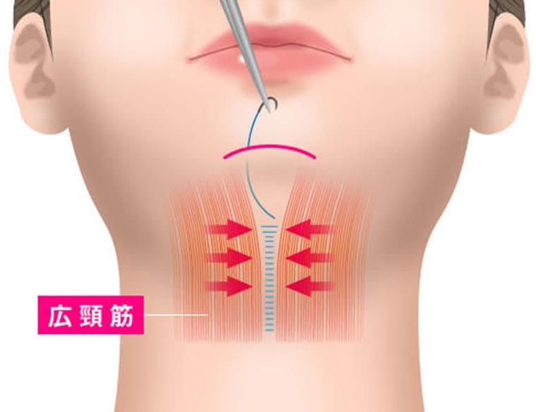 広頚筋を縫い寄せる