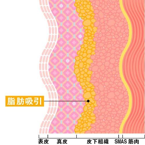 頬・アゴ下の脂肪を除去する