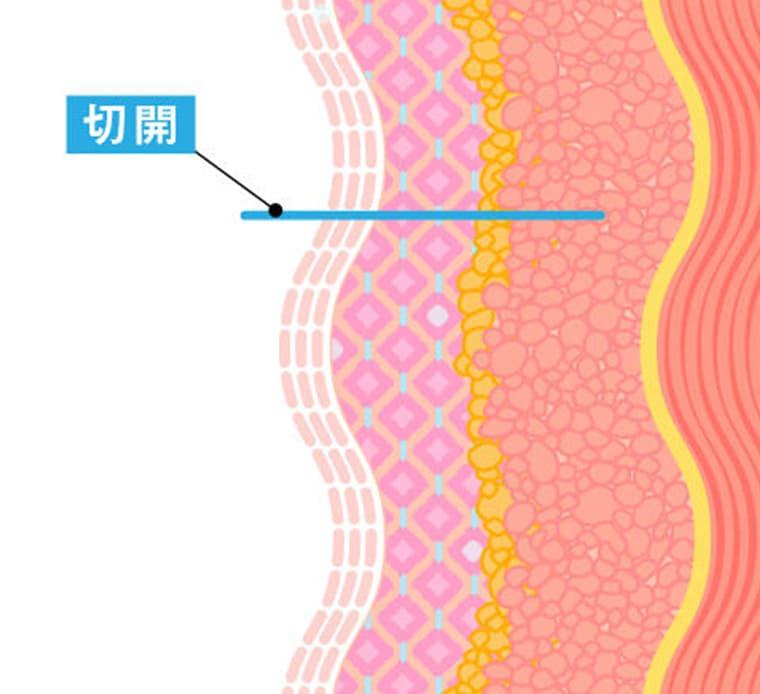 皮膚を切開し、リガメントを処理する