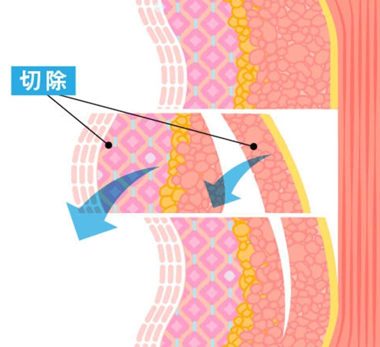 SMASを引き上げる