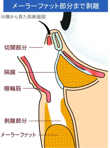 メーラーファットまで剥離する