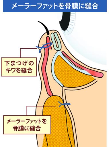 縫合する