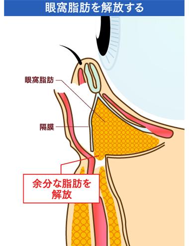 眼窩脂肪を解放する