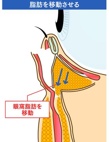 脂肪を移動させる