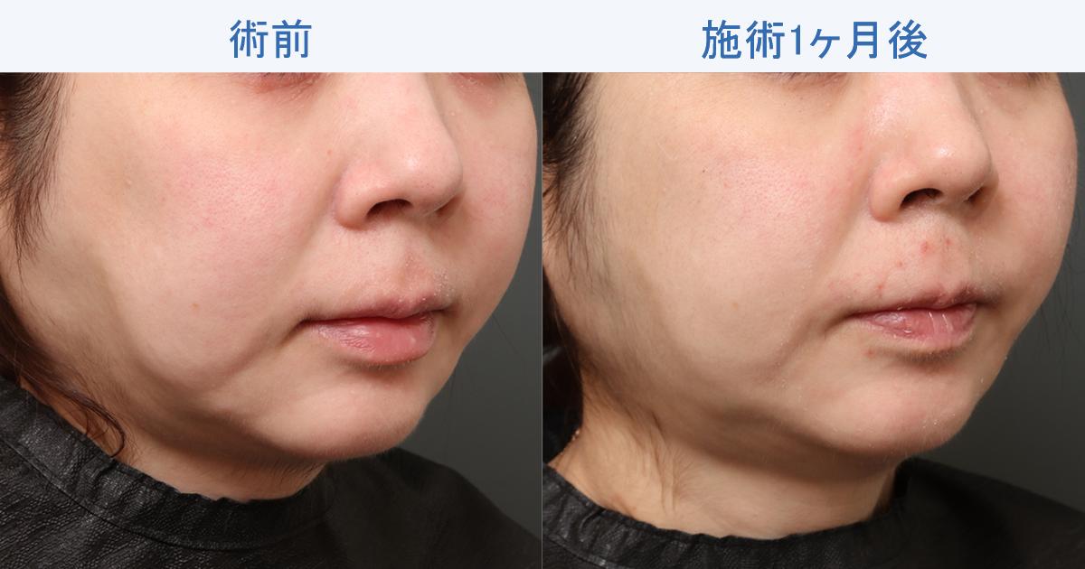 フェイスタイト＋VOVリフトでたるみは改善する？1ヶ月後の変化とは