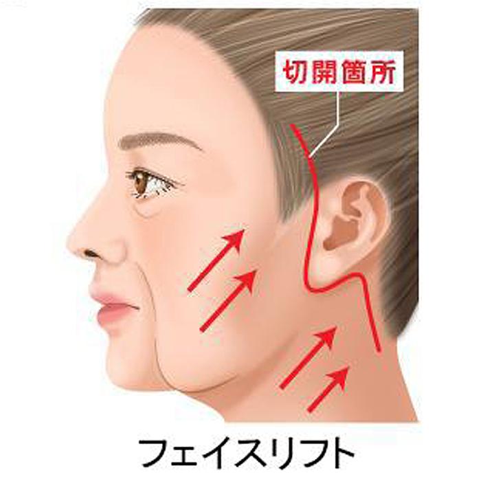 フェイスリフトとは？