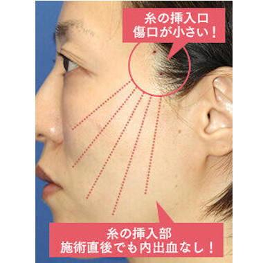 糸リフトの特徴