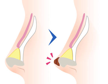 鼻先に軟骨を固定