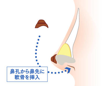 アップノーズの方におすすめの施術：耳介軟骨移植と鼻翼挙上