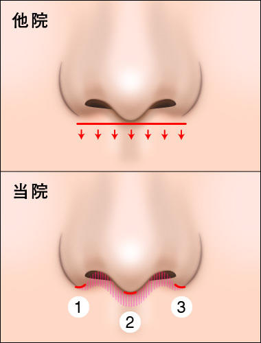 人中短縮（リップリフト）をおこなう上での、当院のこだわり