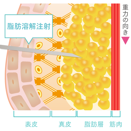 脂肪溶解注射の注入テクニック