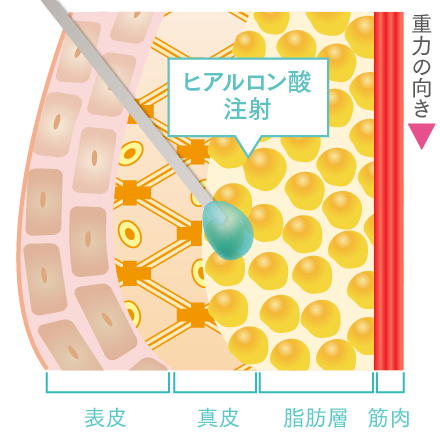 ヒアルロン酸注射の注入テクニック