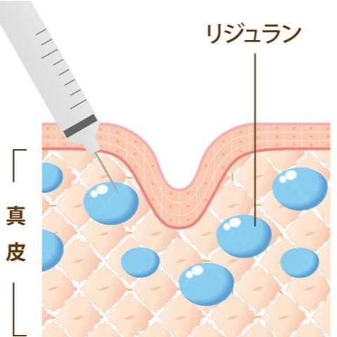 リジュランとスキンボトックスとの違い