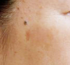 50代女性のシミ・そばかす After 症例写真