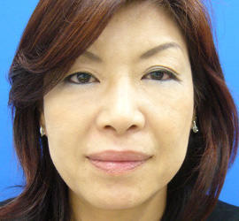 40代女性のPRP皮膚再生療法 After 症例写真