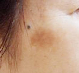 50代女性のシミ・そばかす Before 症例写真