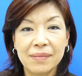 40代女性のPRP皮膚再生療法 Before 症例写真