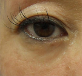 50代女性のPRP皮膚再生療法 After 症例写真