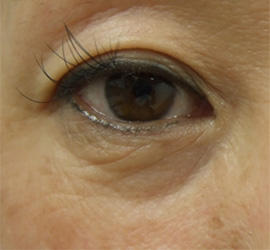 50代女性のPRP皮膚再生療法 Before 症例写真