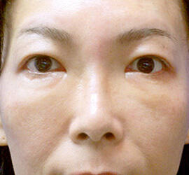 40代女性のアイズバイサメイジ After 症例写真