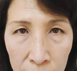50代女性の眉下切開法 After 症例写真