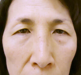 50代女性の眉下切開法 Before 症例写真