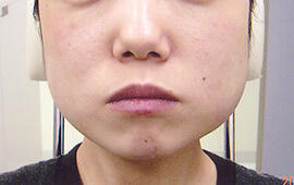 20代女性のボトックス(小顔) Before 症例写真