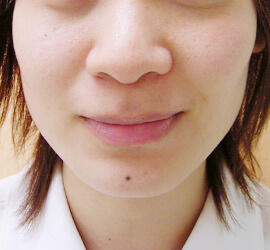 20代女性のボトックス(小顔) Before 症例写真