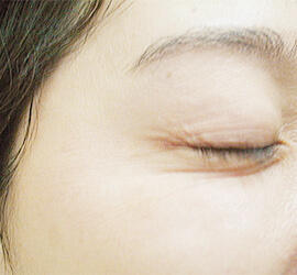 40代女性のシワ・たるみ After 症例写真