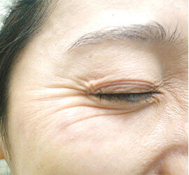 40代女性のシワ・たるみ Before 症例写真